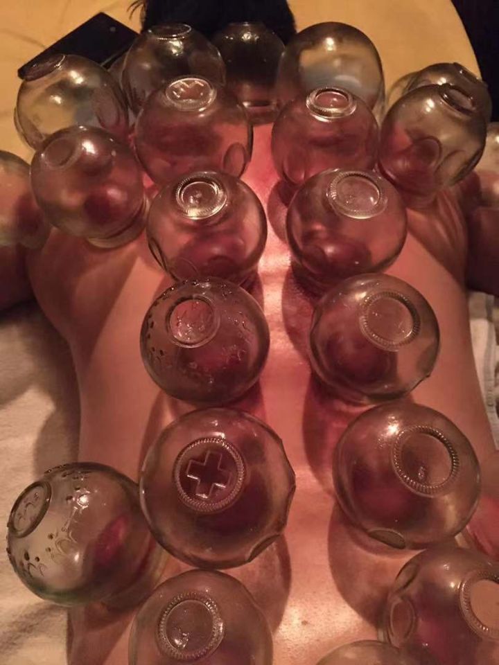 拔罐图.jpg